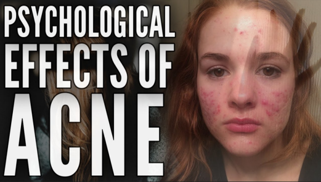 Psychological effect of acne