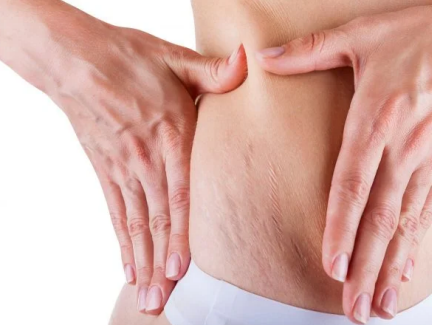 11 Tips on How to Prevent Stretch Marks