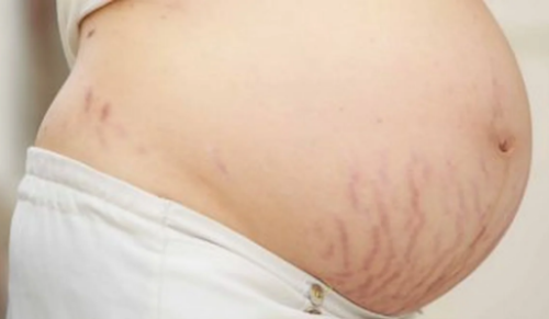 Stretch Mark and the Pregnancy