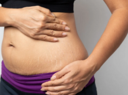 The Causes of Stretch Marks